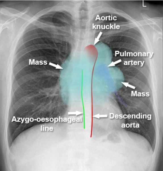 Mediastinalmass.png