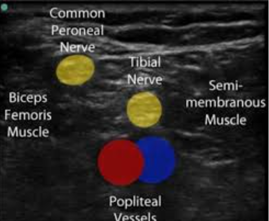 Poplitealsciatic.png